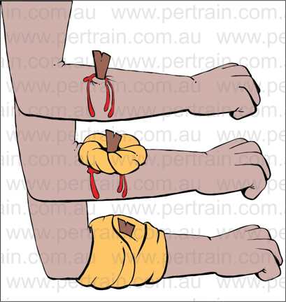 Foreign body in wound