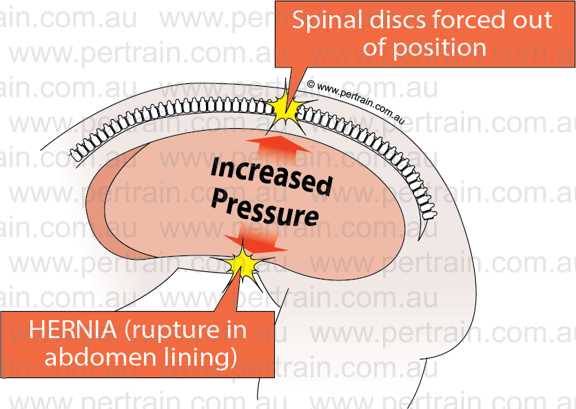 Herniaimage